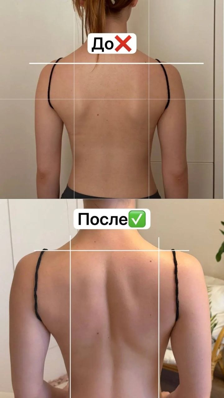 Сравнение состояния осанки
